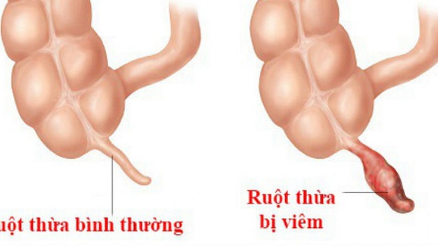 6 dấu hiệu bệnh ruột thừa thường gặp