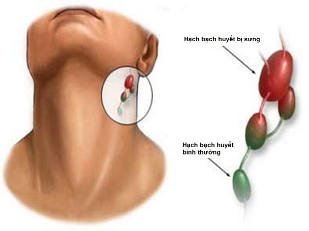 6 dấu hiệu ung thư vòm họng giai đoạn đầu