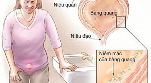 6 nguyên nhân gây đau bụng dưới