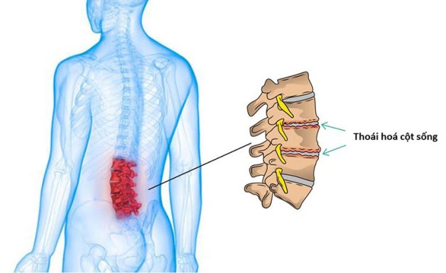 6 nguyên nhân gây ra thoái hóa cột sống bạn lưu ý