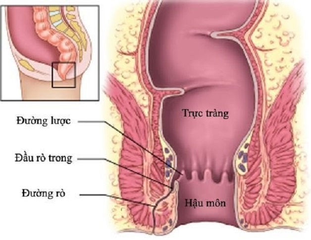 6 nguyên nhân phổ biến gây nên bệnh rò hậu môn