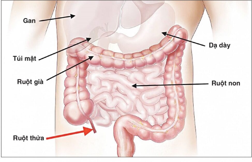 6 Triệu chứng viêm ruột non cần lưu ý