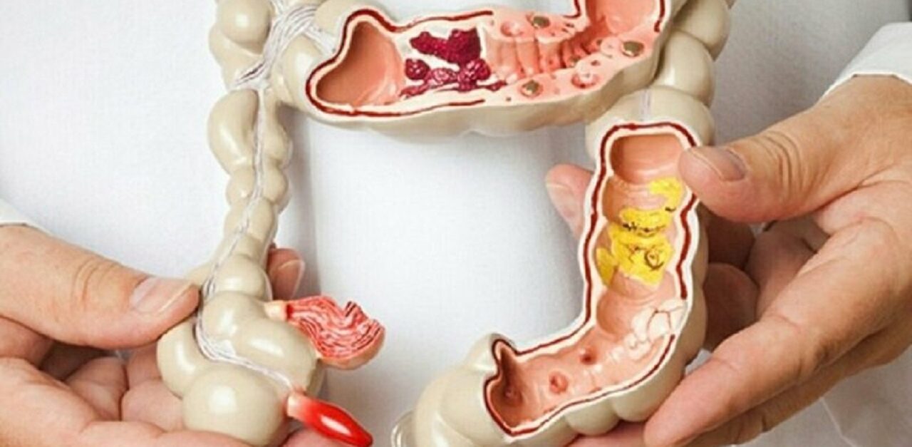 7 biến chứng bệnh Crohn và lưu ý