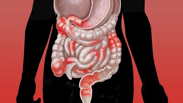 7 biến chứng bệnh Crohn và lưu ý