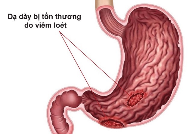 7 cách giảm đau viêm loét dạ dày tức thì 