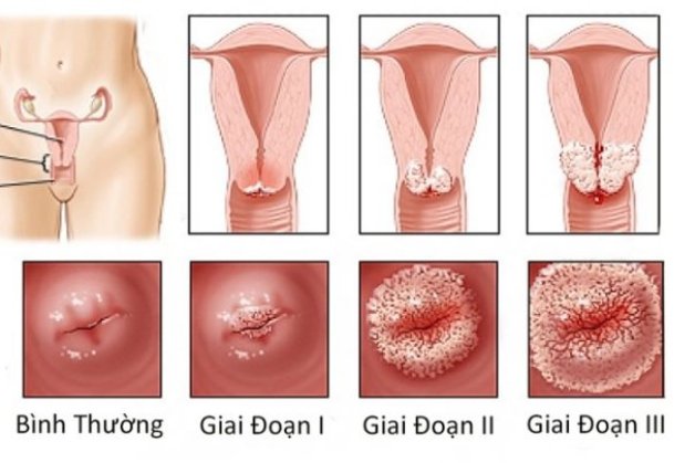 7 dấu hiệu nhắc bạn nên sàng lọc ung thư cổ tử cung sớm