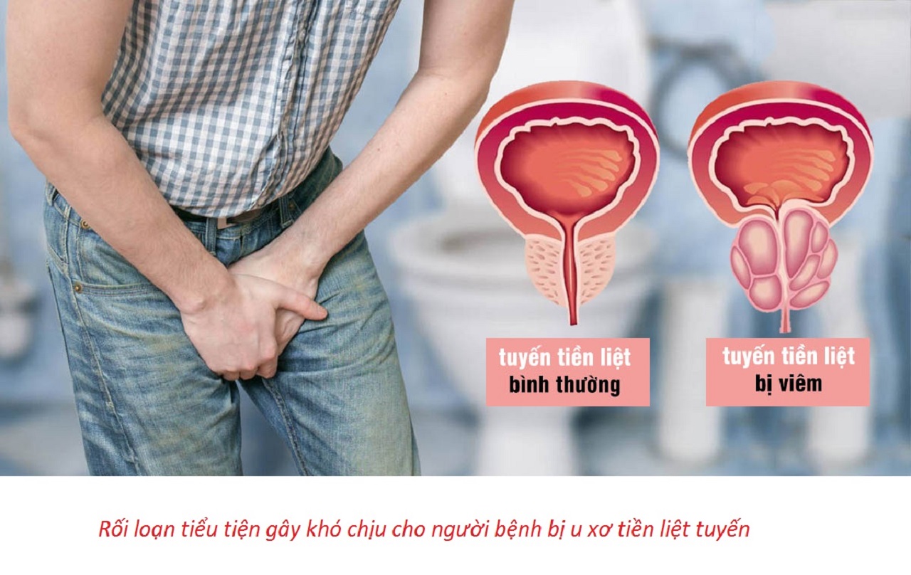 7 dấu hiệu u xơ tuyến tiền liệt không thể bỏ qua