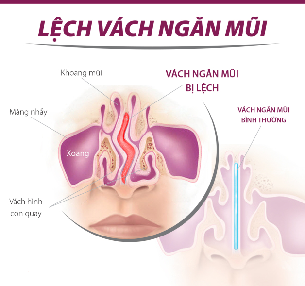 7 dấu hiệu viêm xoang bướm điển hình cần biết sớm