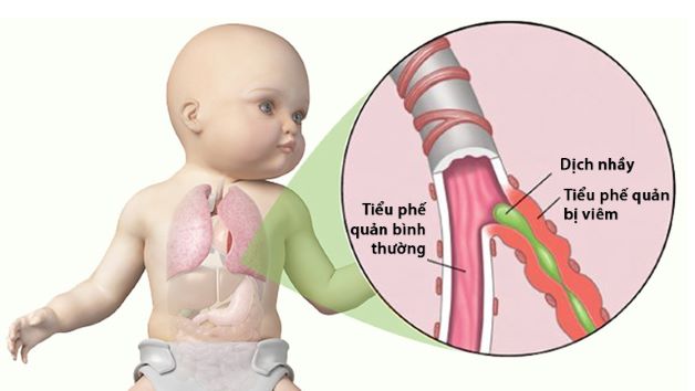 7 Điều phụ huynh cần biết khi trẻ bị viêm tiểu phế quản cấp