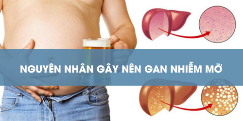 7 nguyên nhân gây bệnh gan nhiễm mỡ không nên coi thường