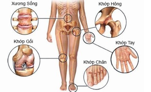 7 nguyên nhân không ngờ khiến bạn bị bệnh khớp