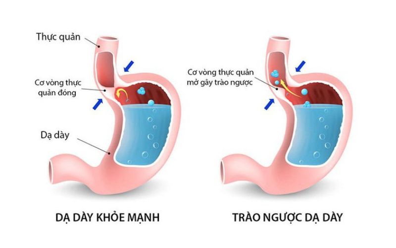 7 Triệu chứng viêm thực quản điển hình cần lưu ý