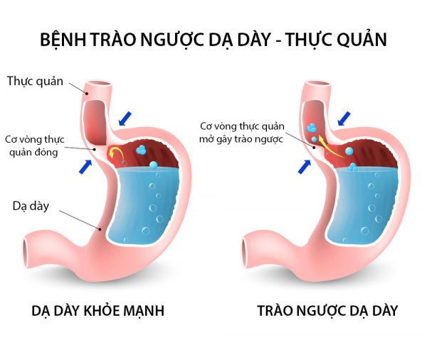 8 dấu hiệu nhận biết trào ngược dạ dày thực quản