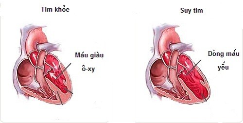 8 điều ít biết về bệnh suy tim