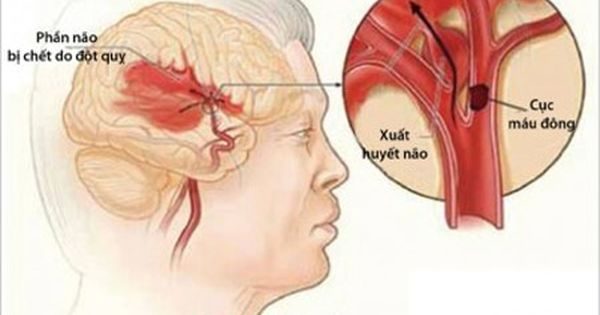 8 triệu chứng xuất huyết não cực kì nguy hiểm