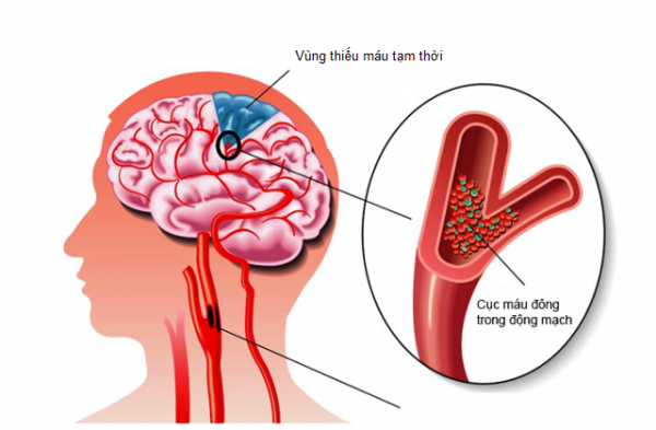 80% trường hợp mất ngủ kinh niên là do thiếu máu lên não