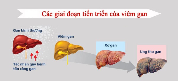 90% bệnh nhân ung thư gan phát hiện ở giai đoạn muộn