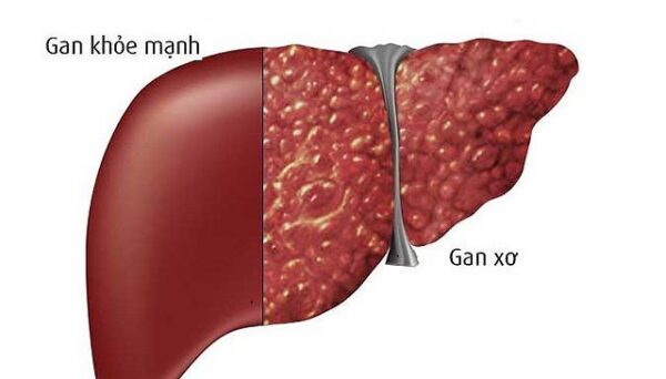 99% người bệnh không biết hết về bệnh xơ gan