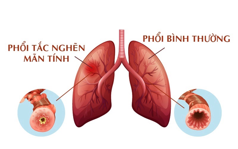 Acetylcystein – Liệu pháp cho bệnh phổi tắc nghẽn mạn tính