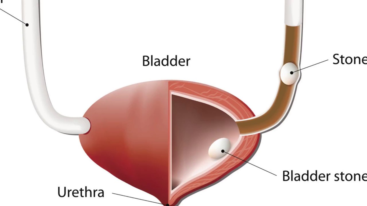 Ai dễ mắc bệnh sỏi bàng quang và cách điều trị như thế nào?