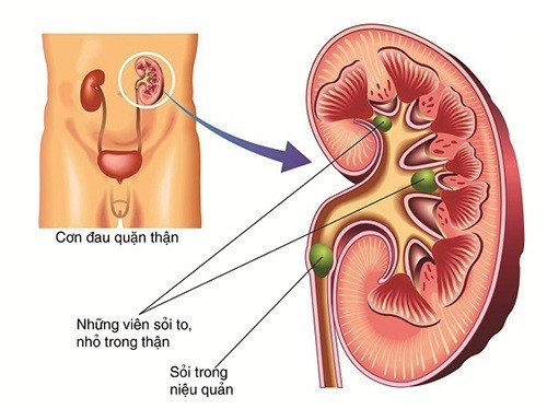 Ai dễ mắc sỏi tiết niệu? dấu hiệu nào nhận biết