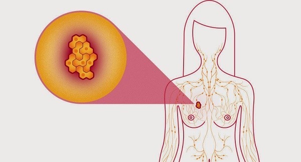 Ai dễ mắc ung thư buồng trứng nhất?