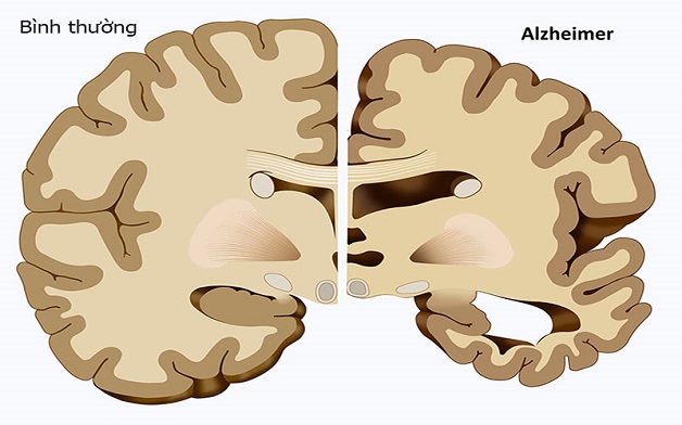 Alzheimer là gì? Nguyên nhân, triệu chứng và cách điều trị