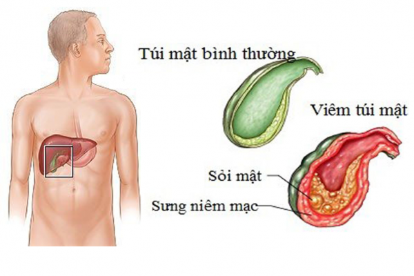 Ăn gì sau mổ sỏi mật?