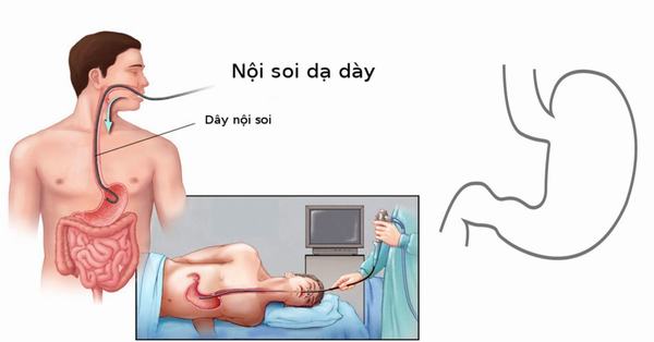 Ăn và nhịn ăn thế nào trước khi nội soi dạ dày?