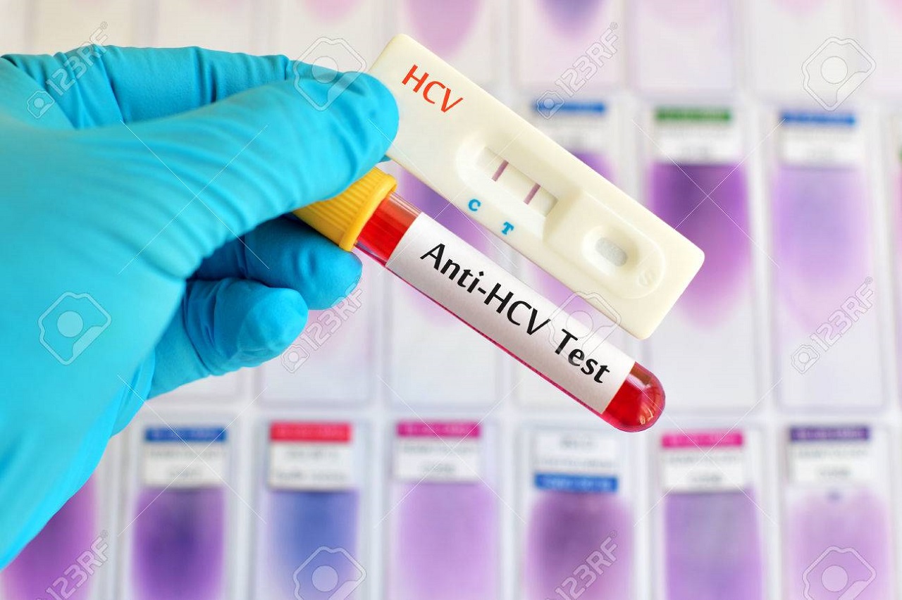 Anti hcv tồn tại bao lâu?điều trị bệnh viêm gan C