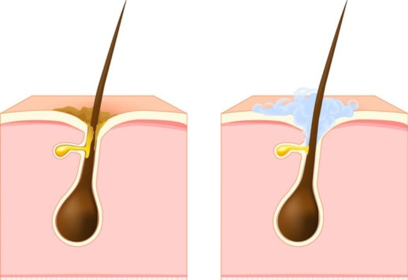 Áp xe mông: nguyên nhân, triệu chứng và điều trị