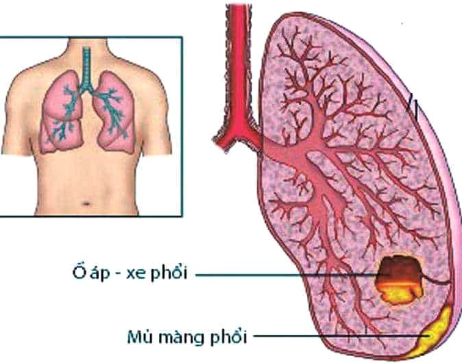 Áp xe phổi ở trẻ em khi nào cần phẫu thuật?