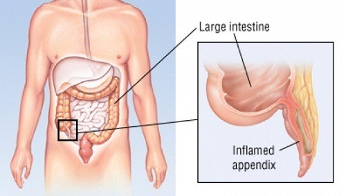 Áp xe ruột thừa là gì?không phải ai cũng biết