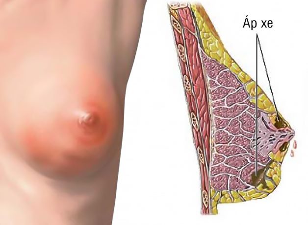 Áp xe vú có nguy hiểm không? Có điều trị được không?