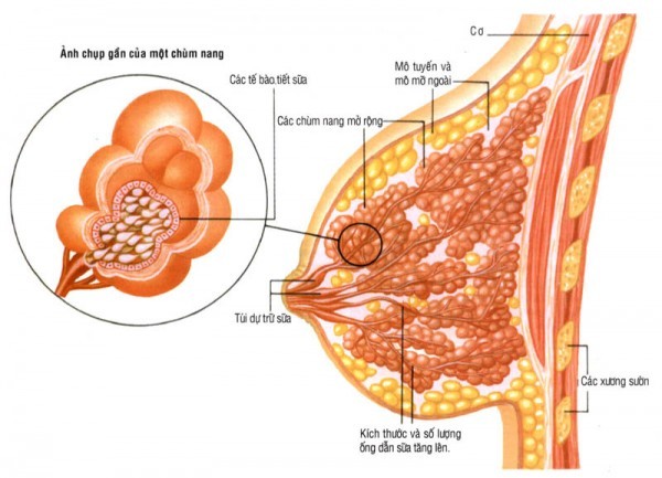 Áp xe vú nguyên nhân do đâu?điều trị bệnh hiệu quả