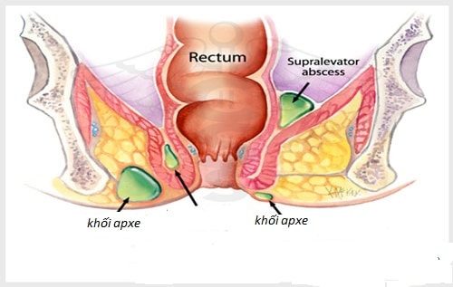 Apxe hậu môn nên ăn gì và kiêng gì?