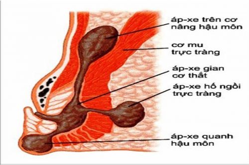 Apxe hậu môn uống thuốc gì?