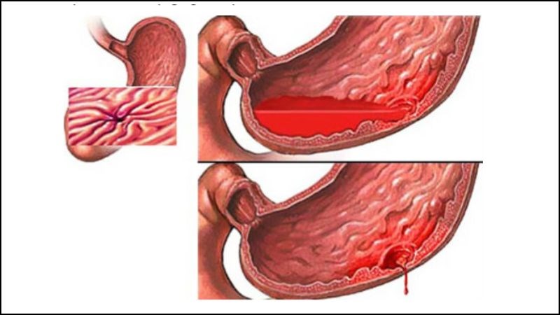 Aspirin: Tìm hiểu toàn diện về công dụng, liều dùng, tác dụng phụ