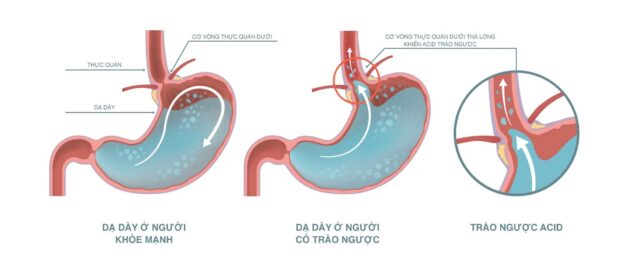 Axit trào ngược: cảnh giác với các biến chứng