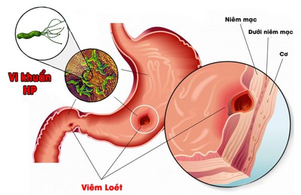 Ba mẹ ngỡ ngàng khi con 8 tuổi bị viêm loét dạ dày, nhiễm HP 