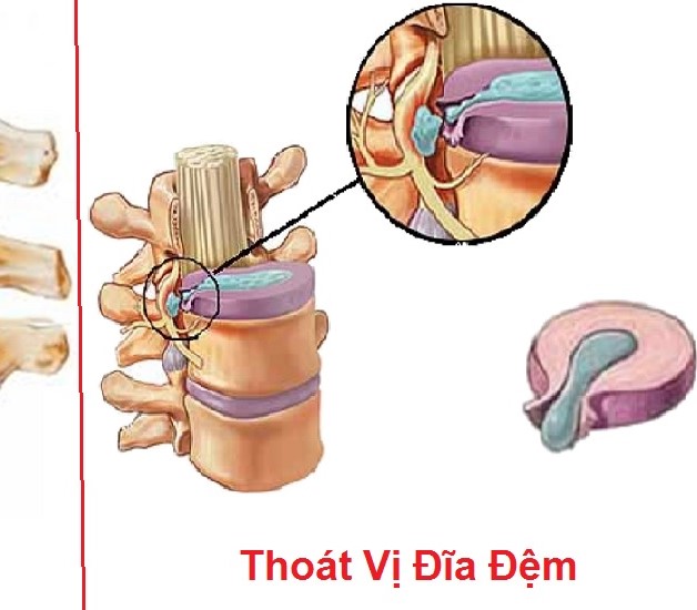 Ba phương pháp trị thoái hóa cột sống cổ hiệu quả cho bạn