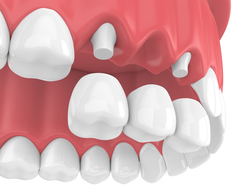 Ba phương pháp trồng răng sứ thẩm mỹ được ưa chuộng hiện nay