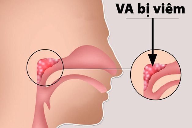 Bác sĩ cảnh báo các dấu hiệu trẻ bị viêm va