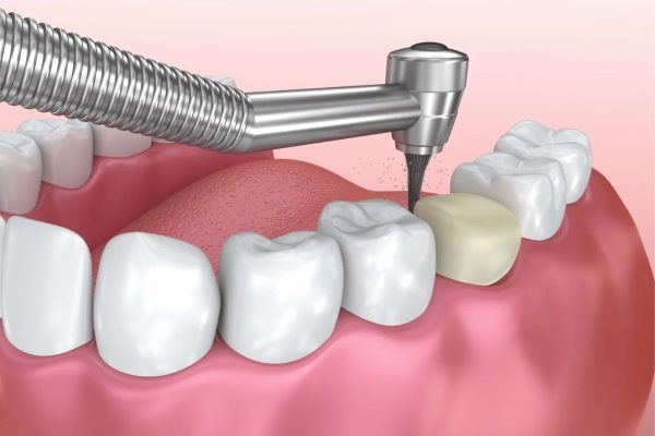 Bác sĩ giải đáp: Bọc răng sứ có phải nhổ răng không?