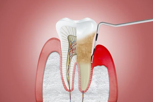 Bác sĩ nha khoa giải đáp: Viêm quanh cuống răng là gì?