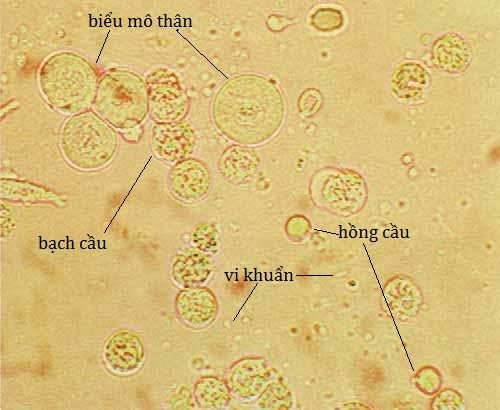 Bạch cầu cao trong nước tiểu khi mang thai có sao không?