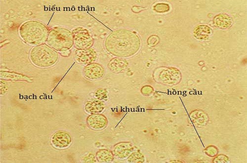 Bạch cầu trong nước tiểu cao khi mang thai có sao không?