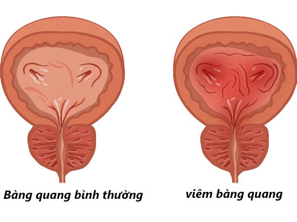 Bài thuốc dân gian chữa đi tiểu nhiều lần trong ngày