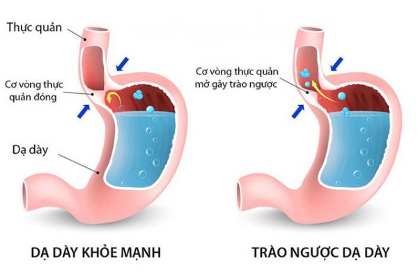 Bạn biết gì về bệnh trào ngược dạ dày thực quản