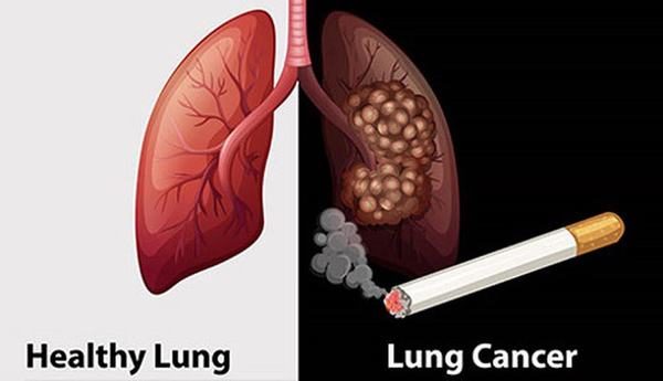 Bạn biết gì về bệnh ung thư phổi?